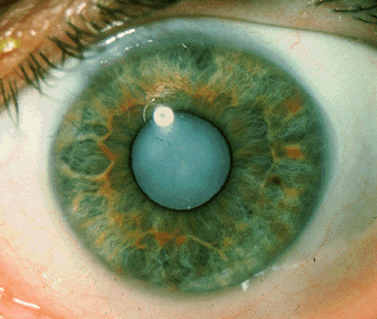 Close up of a green eye with a full cataract.