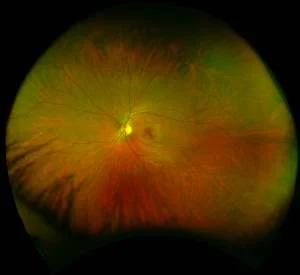 Photo of a person's eye using an Optomap